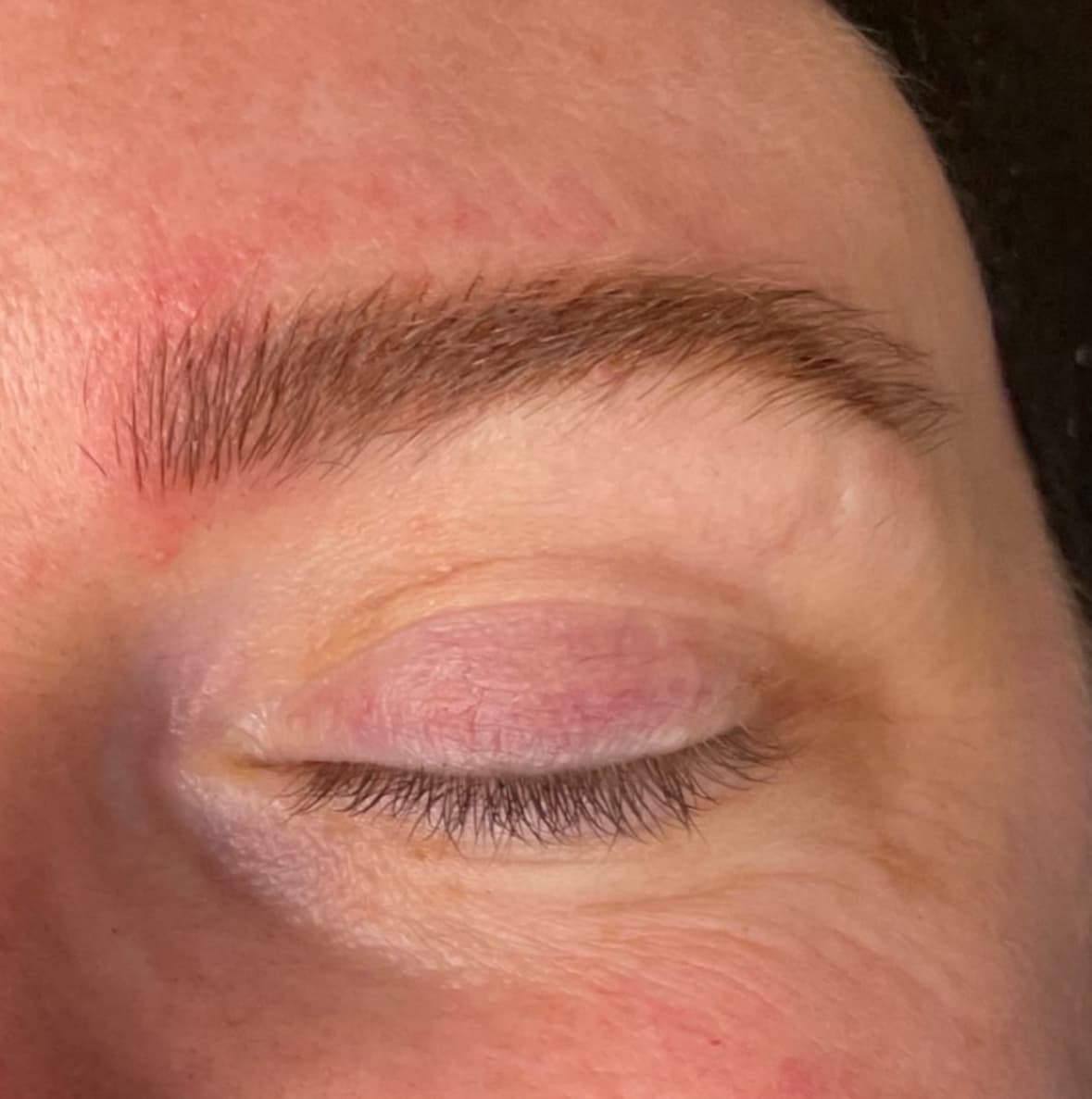 Macro of a closed eye with a brow mid-Li-FT correction session, real client, warm natural light