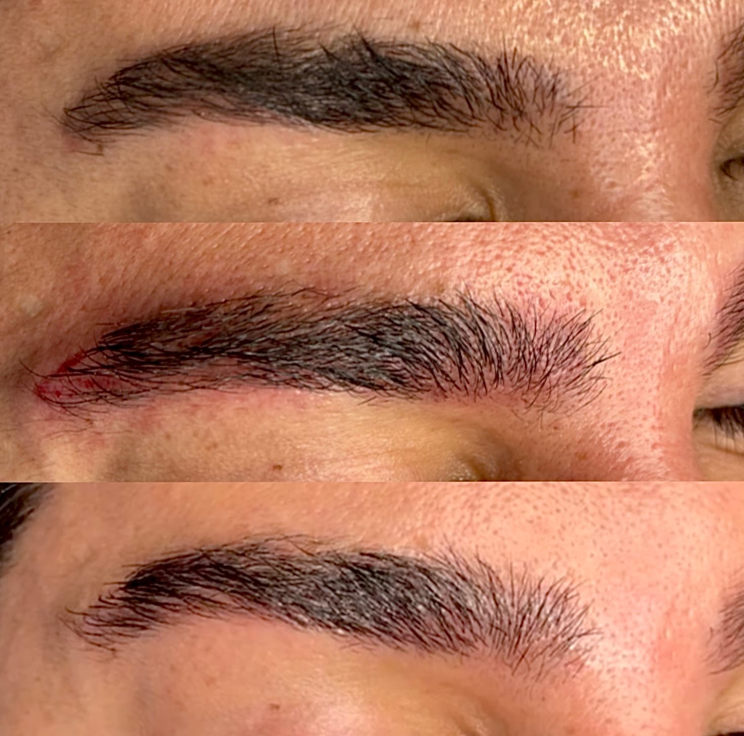 Li-FT saline removal of an old PMU brow in three stages, top to bottom: before, immediately after the appointment, and 8 weeks healed; real client, light skin