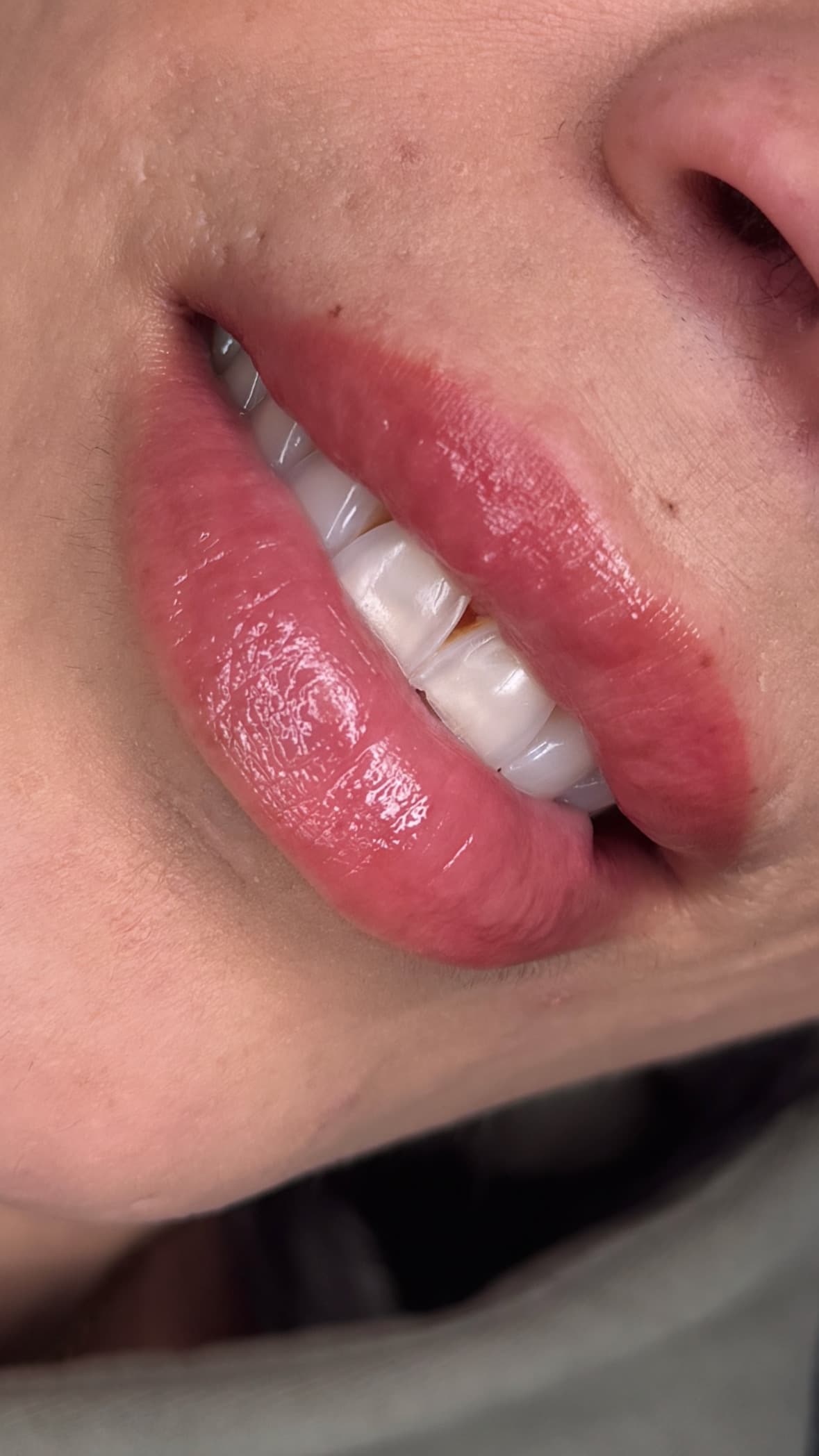 Fresh lip blush on warm medium skin, bold rosy result just after the procedure
