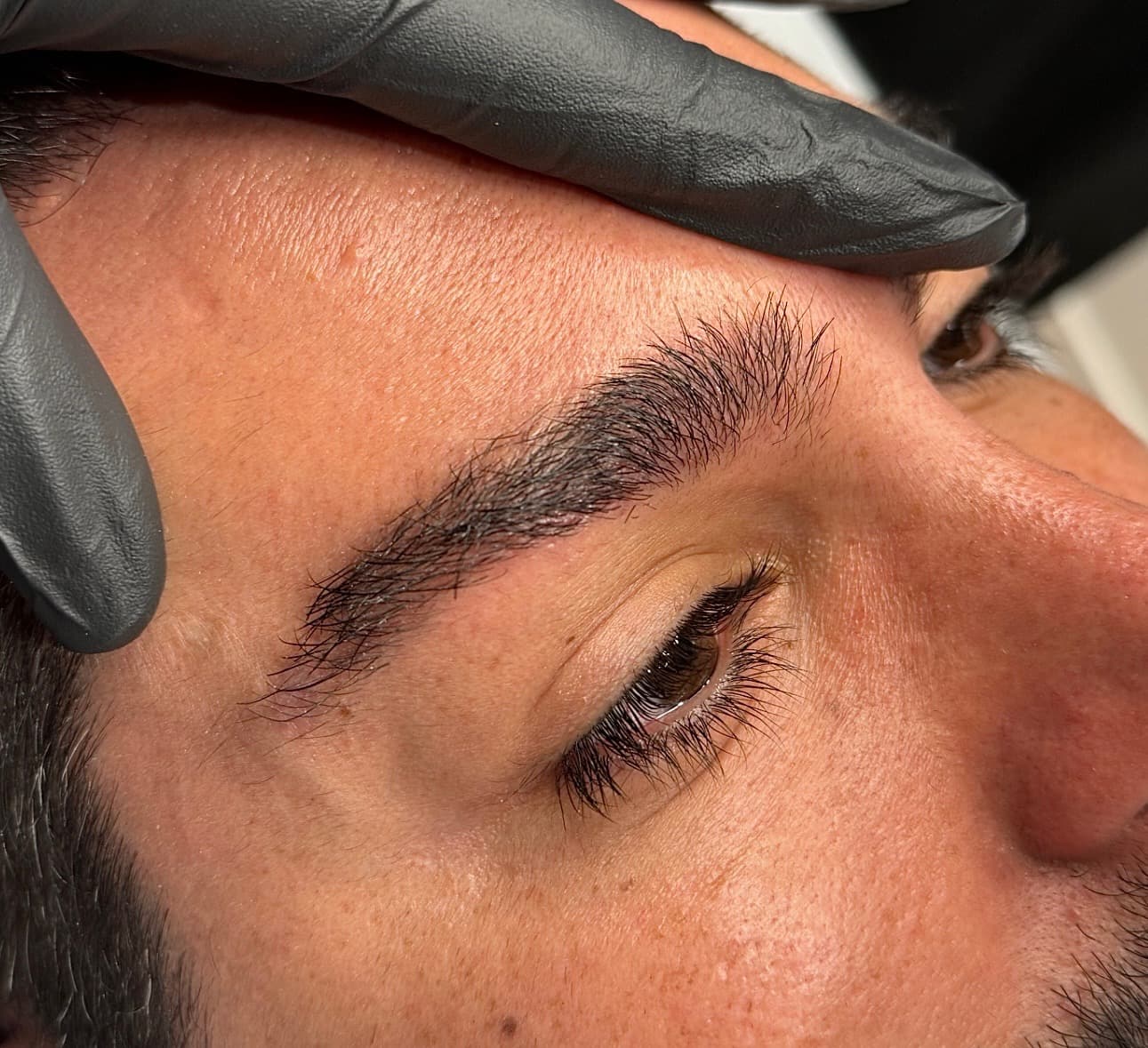 Macro detail of a male client's brow mid-Li-FT saline removal session, gloved hand resting at the brow line